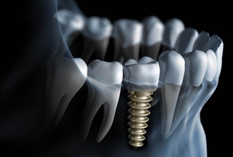 Soluções e possibilidades de tratamento com os implantes dentários