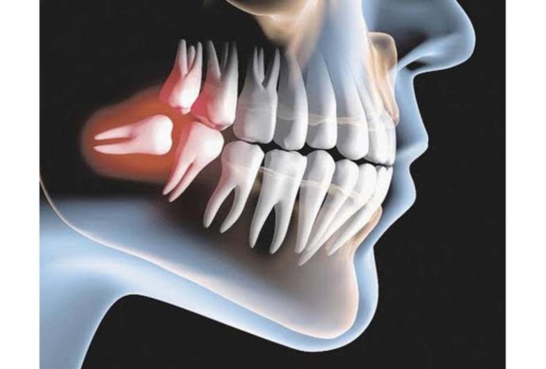 O que acontece com o dente do siso?