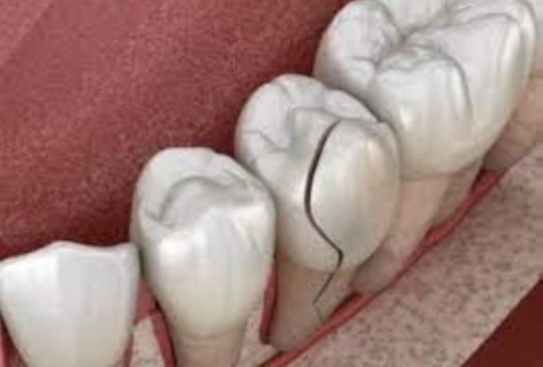 Toda trinca no dente exige tratamento?