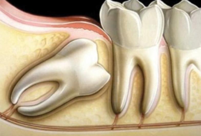 Os dentes do siso estão nascendo, é preciso extrair?