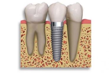 Soluções e possibilidades de  tratamento com os implantes dentários