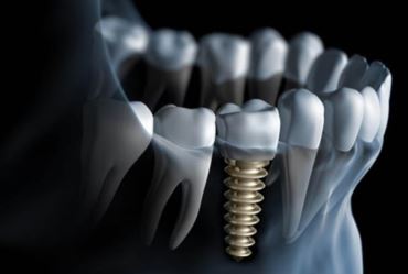 Soluções e possibilidades de tratamento com os implantes dentários