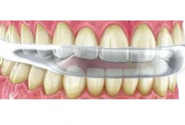 Placas de bruxismo e protetores bucais esportivos, quais as diferenças?