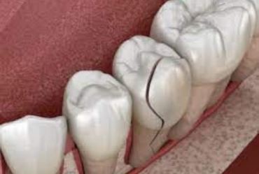 Toda trinca no dente exige tratamento?