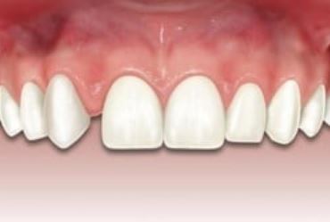 Como ocorrem as anomalias dentárias?