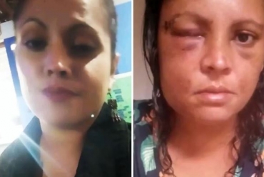 Grávida teve rosto 'deformado' após ser espancada por marido e revela dificuldade de olhar no espelho: 'Toda vez eu choro'